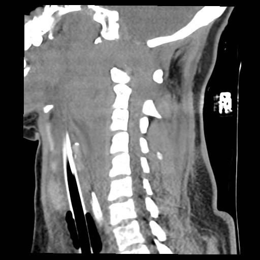 File:Atlanto-occipital dislocation (Radiopaedia 44648-48412 A 12).jpg