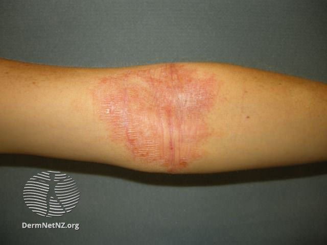File:Atopic dermatitis (DermNet NZ dermatitis-flexural-eczema12).jpg