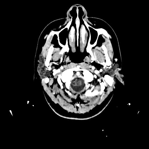 Atretic cephalocele (Radiopaedia 89782-106881 Axial with contrast 13).jpg