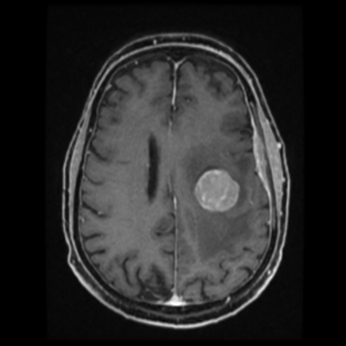 Atypical meningioma (Radiopaedia 45535-49629 Axial T1 C+ 46).jpg