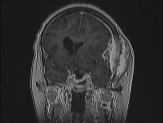Atypical meningioma (Radiopaedia 62985-71406 Coronal T1 C+ 41).jpg
