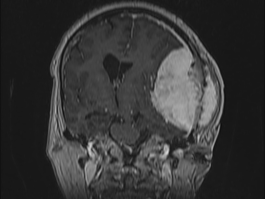 Atypical meningioma (Radiopaedia 62985-71406 Coronal T1 C+ 57).jpg