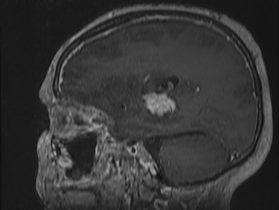 Atypical meningioma (Radiopaedia 62985-71406 Sagittal T1 C+ 61).jpg