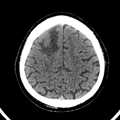 File:Atypical meningioma (WHO grade II) with brain invasion (Radiopaedia 57767-64728 Axial non-contrast 34).png