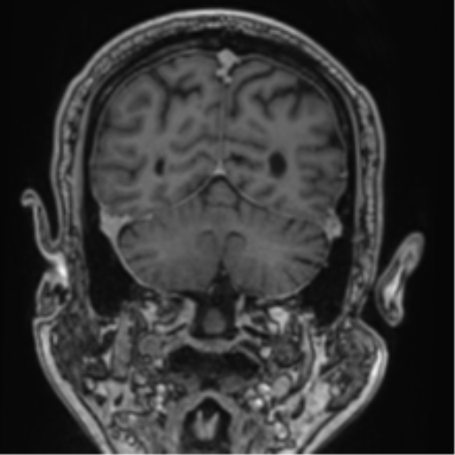 File:Atypical meningioma (WHO grade II) with brain invasion (Radiopaedia 57767-64729 Coronal T1 C+ 64).png