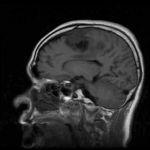 File:Atypical meningioma (WHO grade II) with osseous invasion (Radiopaedia 53654-59716 Sagittal T1 14).png