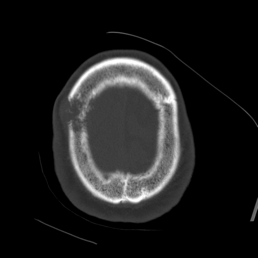 File:Atypical meningioma with skull invasion (Radiopaedia 34357-35649 Axial bone window 72).png