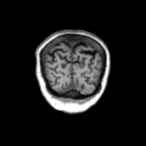 Autoimmune limbic encephalitis (Radiopaedia 30363-31005 Coronal T1 8).jpg
