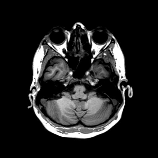 File:Autoimmune limbic encephalitis (Radiopaedia 30363-31005 T1 Axial 1mm 39).jpg