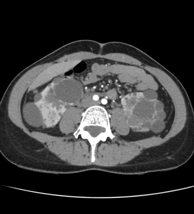 Autosomal dominant polycystic kidney disease - early onset (Radiopaedia 40734-43387 B 42).jpg