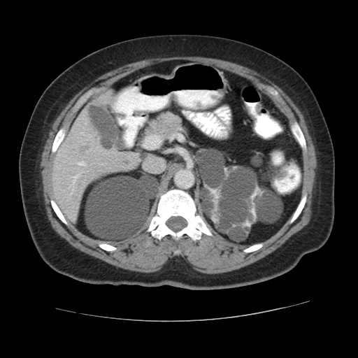 Autosomal dominant polycystic kidney disease with hepatic involvement (Radiopaedia 32693-33662 B 25).jpg