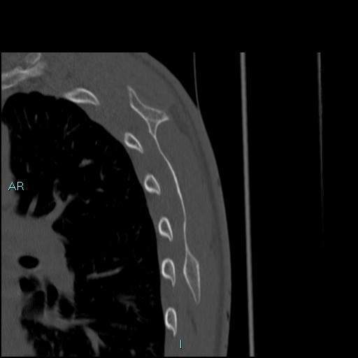 File:Avascular necrosis after fracture dislocations of the proximal humerus (Radiopaedia 88078-104653 Sagittal bone window 79).jpg