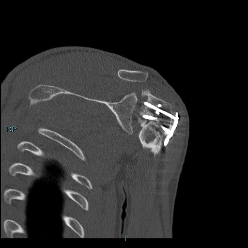 Avascular necrosis after fracture dislocations of the proximal humerus (Radiopaedia 88078-104655 Coronal bone window 84).jpg