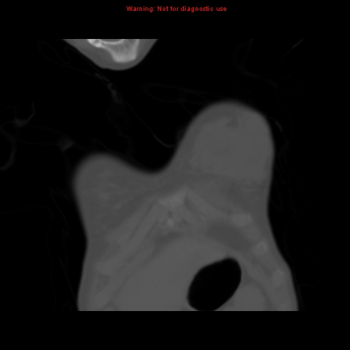 File:Avascular necrosis in sickle cell disease (Radiopaedia 17448-17152 Coronal bone window 7).jpg