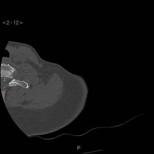 File:Avascular necrosis of the shoulder - Cruess stage I (Radiopaedia 77674-89887 Axial bone window 3).jpg