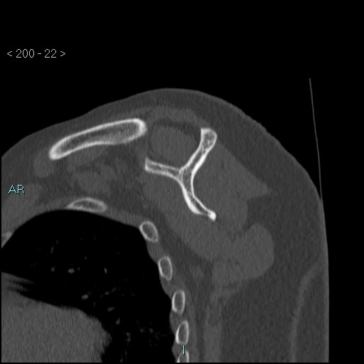 Avascular necrosis of the shoulder - Cruess stage I (Radiopaedia 77674-89887 Sagittal bone window 21).jpg