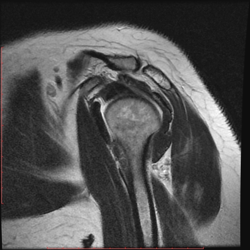 File:Avulsion fracture - greater tuberosity of humerus (Radiopaedia 25457-25703 Sagittal T2 5).jpg