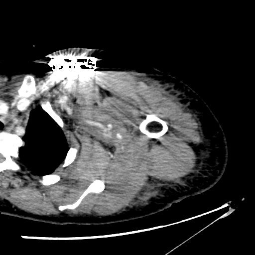 File:Axillary arterial pseudoaneurysm (Radiopaedia 24925-25195 A 7).jpg