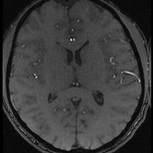 Azygos anterior cerebral artery (Radiopaedia 17059-16756 Axial MRA 3).jpg