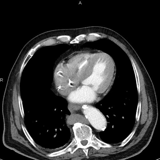 File:Azygos continuation of the inferior vena cava (Radiopaedia 18537-18404 C+ arterial phase 39).jpg