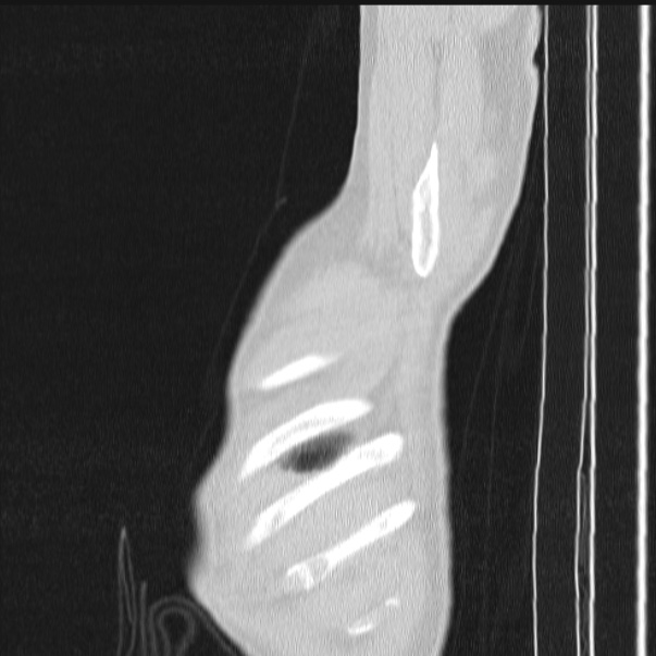 Azygos lobe (Radiopaedia 38259-40275 lung window 97).jpg