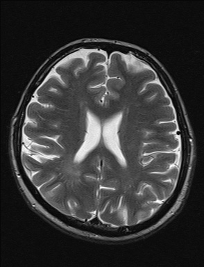 File:Balo concentric sclerosis (Radiopaedia 50458-55940 Axial T2 17).jpg
