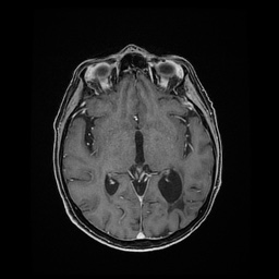 File:Balo concentric sclerosis (Radiopaedia 53875-59982 Axial LAVA C+ 128).jpg