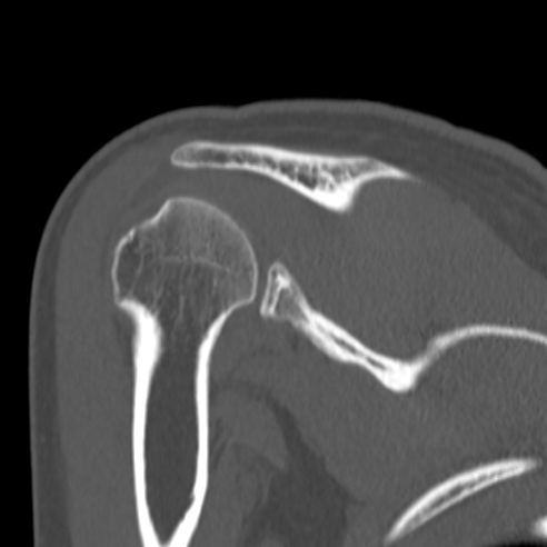 Bankart lesion (Radiopaedia 57256-64185 Coronal bone window 33).jpg