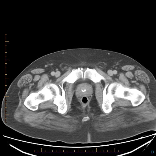 File:Bariatric balloon causing gastric outlet obstruction (Radiopaedia 54449-60672 A 43).jpg