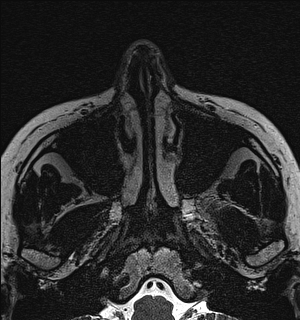 Basal cell carcinoma - nasal region (Radiopaedia 70292-80365 Axial Gradient Echo 11).jpg