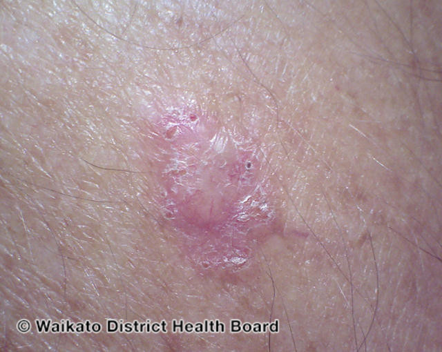 File:Basal cell carcinoma affecting the arms and legs 10 macro (DermNet NZ bcc-10-macro).jpg