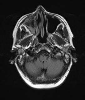 File:Base of skull chondrosarcoma (Radiopaedia 30410-31070 Axial FLAIR 3).jpg