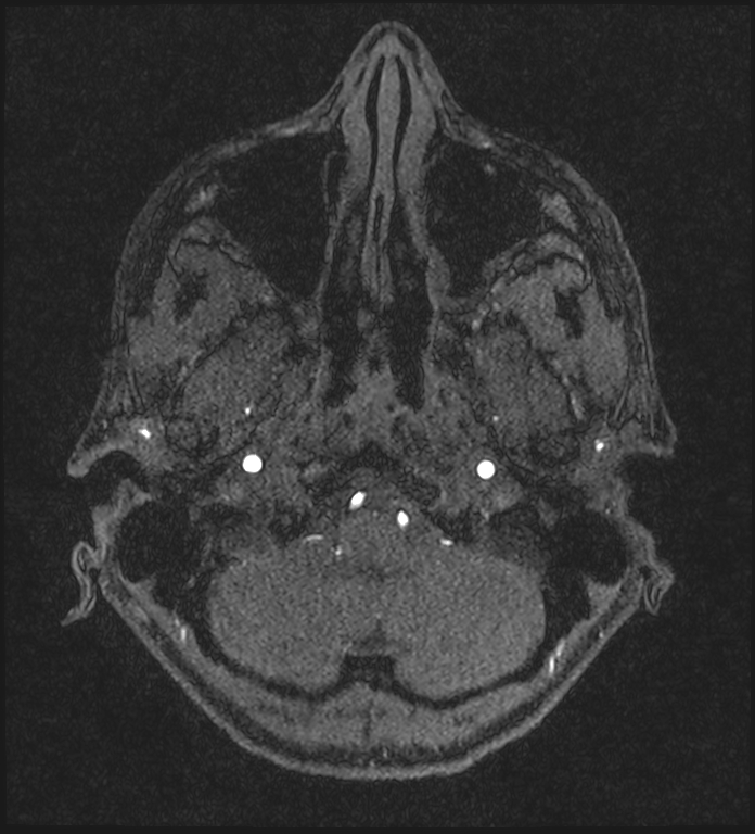 Basilar artery perforator aneurysm (Radiopaedia 82455-97733 Axial MRA 34).jpg