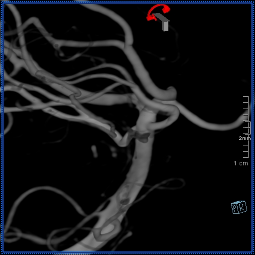 Basilar artery perforator aneurysm (Radiopaedia 82455-99524 3D Left VA 73).jpg