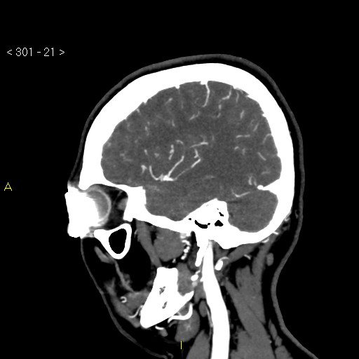 Basilar artery thrombosis (Radiopaedia 16260-15944 C 15).jpg