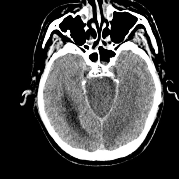 Basilar artery thrombosis (Radiopaedia 53351-59352 Axial non-contrast 46).jpg