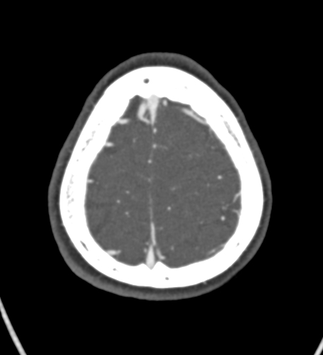 Basilar tip aneurysm with coiling (Radiopaedia 53912-60086 A 131).jpg