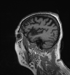 Behavioral variant frontotemporal dementia and late onset schizophrenia (Radiopaedia 52197-58083 Sagittal T1 87).png