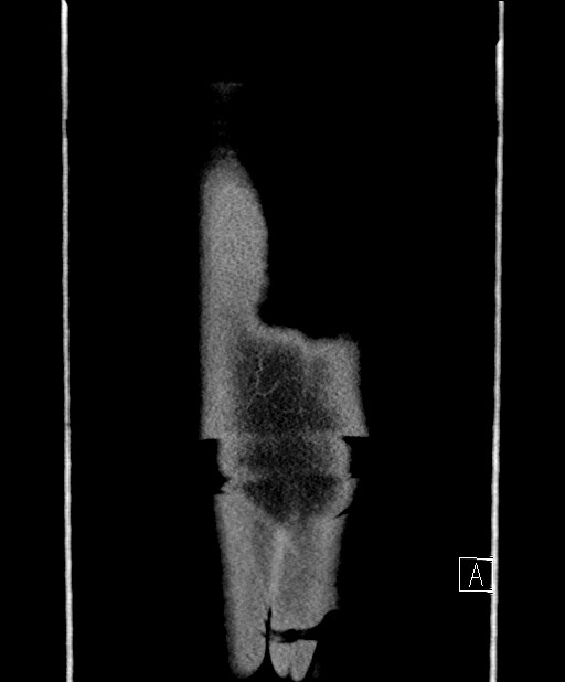 Benign colonic stricture with colo-colonic fistula (Radiopaedia 59439-66800 A 82).jpg