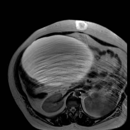 File:Benign seromucinous cystadenoma of the ovary (Radiopaedia 71065-81300 B 31).jpg
