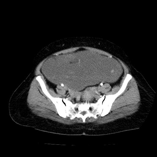 Benign spindle cell tumor - abdominopelvic (Radiopaedia 61300-69212 A 48).jpg