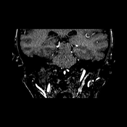 File:Berry aneurysm of the terminal internal carotid artery (Radiopaedia 88286-104918 Coronal TOF 64).jpg