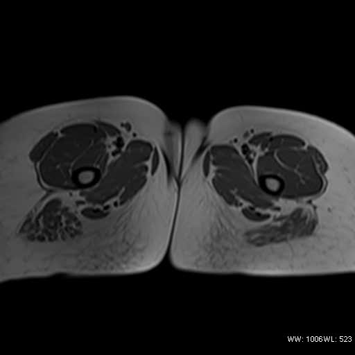 File:Bicornuate uterus- on MRI (Radiopaedia 49206-54297 Axial T1 22).jpg