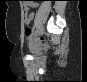 File:Bicornuate uterus (MRI) (Radiopaedia 49206-54296 Sagittal 10).png