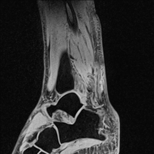Bilateral Achilles tendon complete tear (Radiopaedia 81344-95051 Sagittal WE - Left 78).jpg