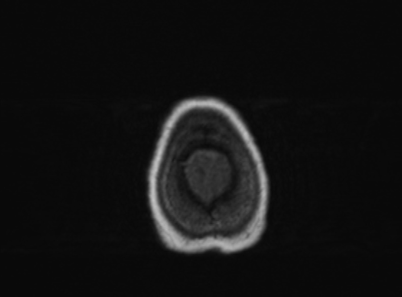Bilateral PCA territory infarction - different ages (Radiopaedia 46200-51784 Axial T1 110).jpg