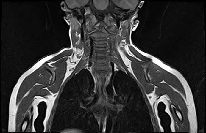 File:Bilateral Sprengel deformity with Klippel-Feil syndrome (Radiopaedia 66395-75650 Coronal T1 13).jpg