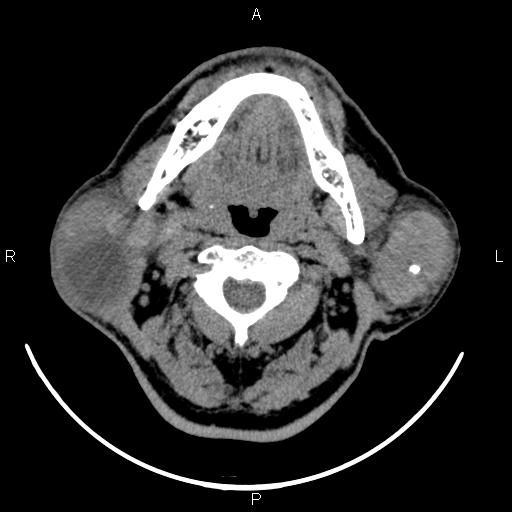 Bilateral Warthin tumors (Radiopaedia 84034-99263 Axial non-contrast 24).jpg