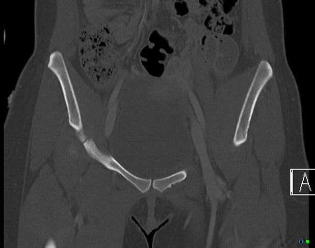 File:Bilateral acetabular fractures (Radiopaedia 79272-92308 Coronal bone window 9).jpg