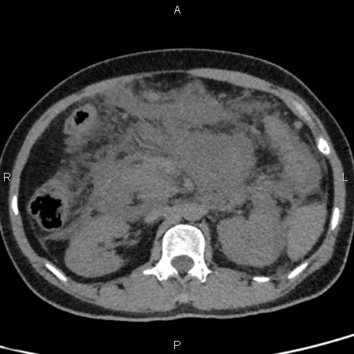 Bilateral adrenal gland hyperenhancement in pancreatitis (Radiopaedia 86642-102753 Axial non-contrast 46).jpg